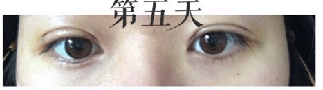 上海九院金蓉医生做的双眼皮手术果