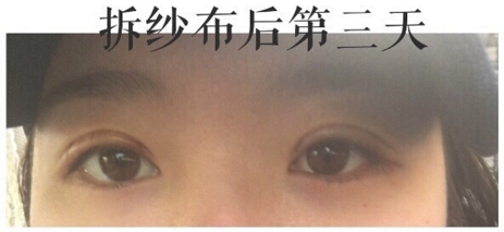 上海九院金蓉医生做的双眼皮手术果
