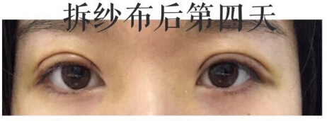 上海九院金蓉医生做的双眼皮手术果