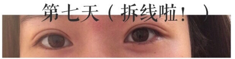 上海九院金蓉医生做的双眼皮手术果
