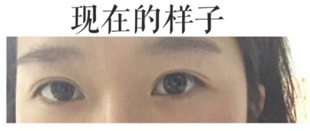 上海九院金蓉医生做的双眼皮手术果
