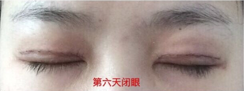 上海九院朱海男医生做的全切双眼皮