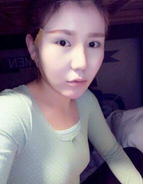 成都艾米丽医疗美容刘叔阳面部吸脂果