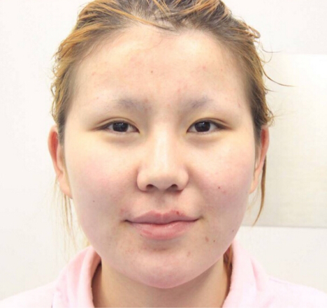 成都艾米丽医疗美容刘叔阳面部吸脂果