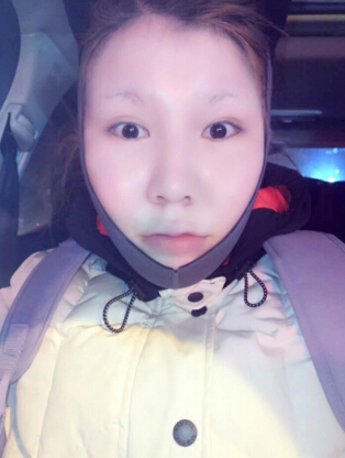 成都艾米丽医疗美容刘叔阳面部吸脂果