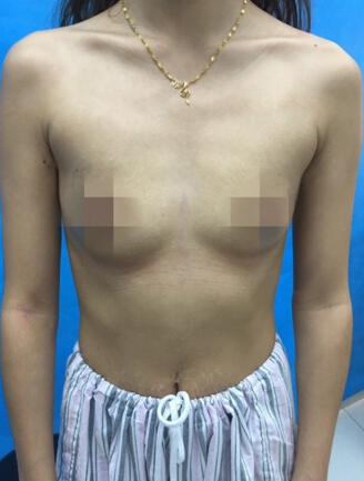 重庆五洲整形美容范文亮假体隆胸果