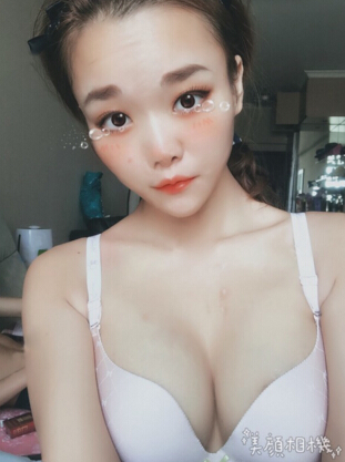 重庆五洲整形美容范文亮假体隆胸果