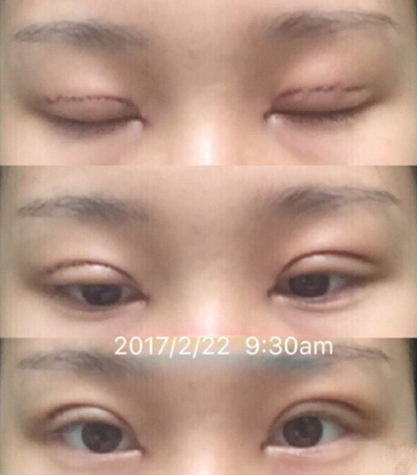 吕方中主任做的全切双眼皮开内眼角手