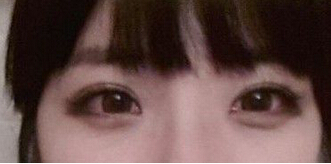自体软骨隆鼻手术大概需要花多少钱?