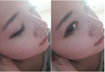 自体软骨隆鼻手术大概需要花多少钱?