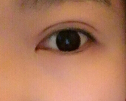 上海某整形医院香港医生做的全切加开眼角