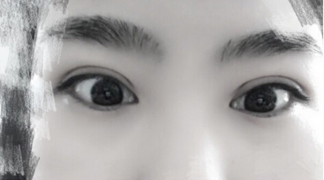 洛阳华美整形常主任处做的全切双眼皮,价格4