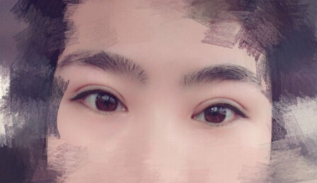 洛阳华美整形常主任处做的全切双眼皮,价格4