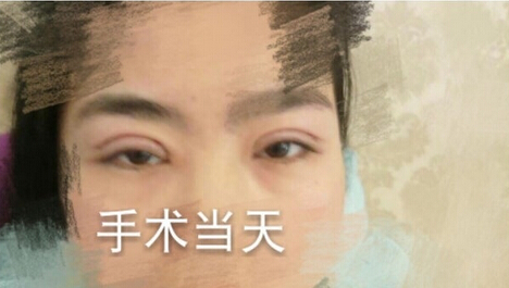 洛阳华美整形常主任处做的全切双眼皮,价格4