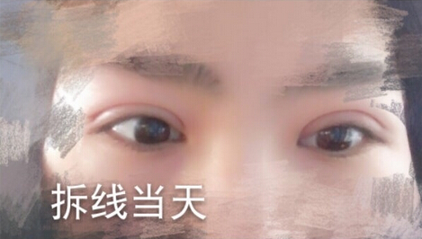 洛阳华美整形常主任处做的全切双眼皮,价格4
