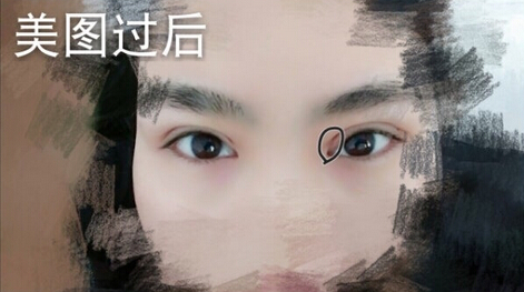 洛阳华美整形常主任处做的全切双眼皮,价格4