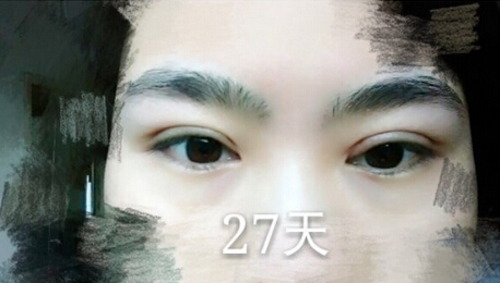 洛阳华美整形常主任处做的全切双眼皮,价格4