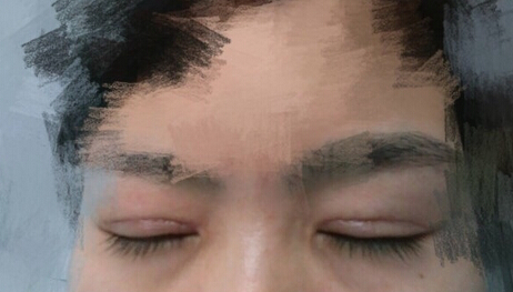 洛阳华美整形常主任处做的全切双眼皮,价格4