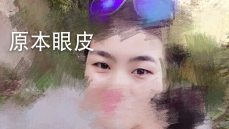 洛阳华美整形常主任处做的全切双眼皮,价格4
