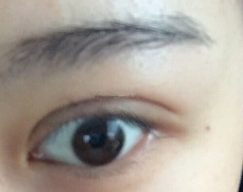 武汉同济做微创双眼皮手术果怎么样?