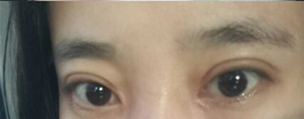 天津武警医院做的全切双眼皮、去皮去脂手术