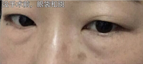 北京八大处王永前主任做的外切眼袋和激光祛斑