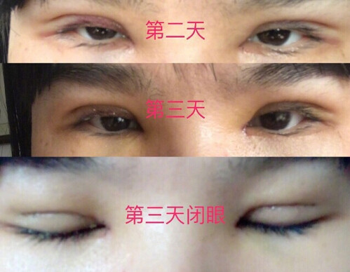 泉州美莱华美林丽德伤口凹陷以后会恢复吗?