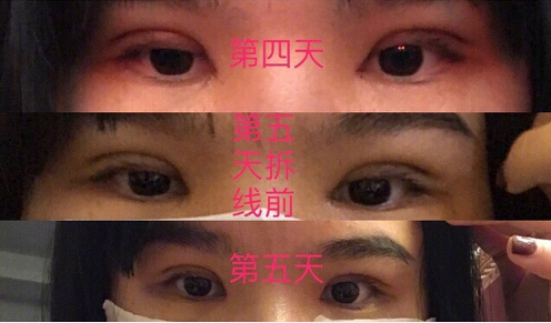 泉州美莱华美林丽德伤口凹陷以后会恢复吗?