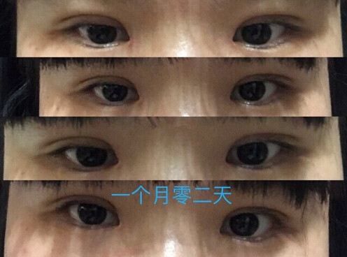 泉州美莱华美林丽德伤口凹陷以后会恢复吗?