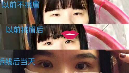 泉州美莱华美林丽德伤口凹陷以后会恢复吗?