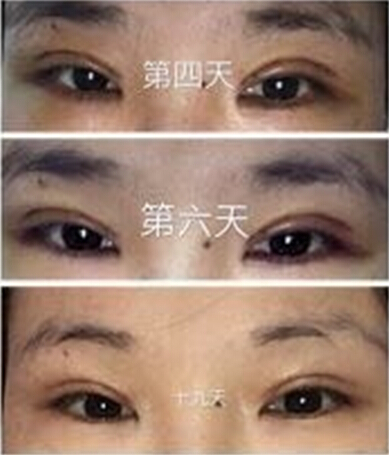 上海九院做的全切双眼皮手术果