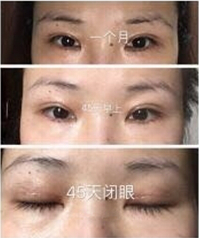 上海九院做的全切双眼皮手术果