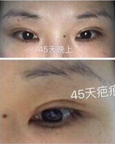 上海九院做的全切双眼皮手术果