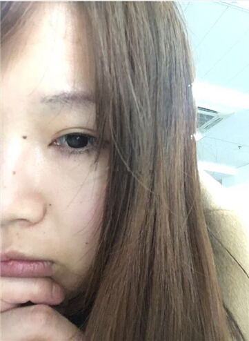 上海九院做的全切双眼皮手术果