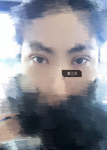 甘肃酒泉眼科医生做的多点定位双眼皮手术果