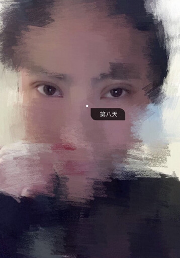 甘肃酒泉眼科医生做的多点定位双眼皮手术果