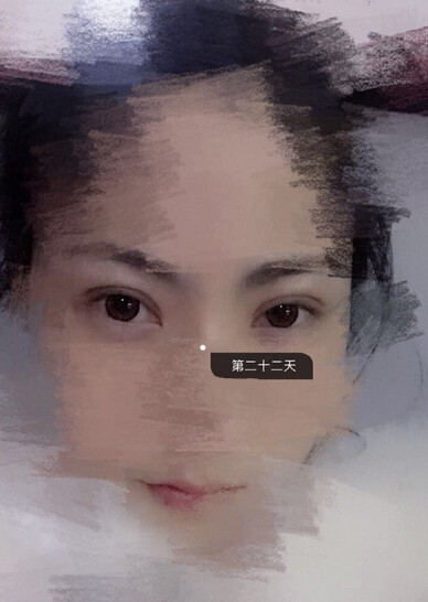 甘肃酒泉眼科医生做的多点定位双眼皮手术果