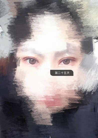 甘肃酒泉眼科医生做的多点定位双眼皮手术果