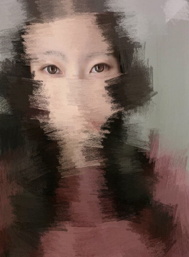 甘肃酒泉眼科医生做的多点定位双眼皮手术果