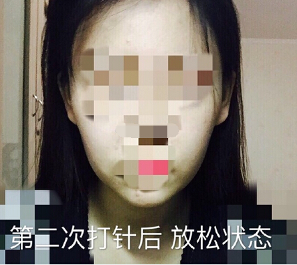 注射瘦脸案例反馈一例