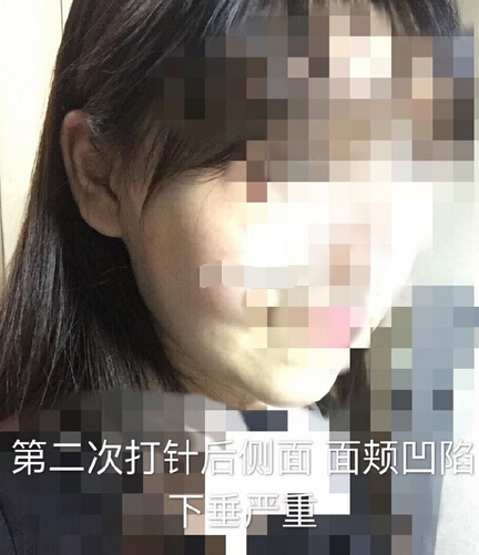 注射瘦脸案例反馈一例