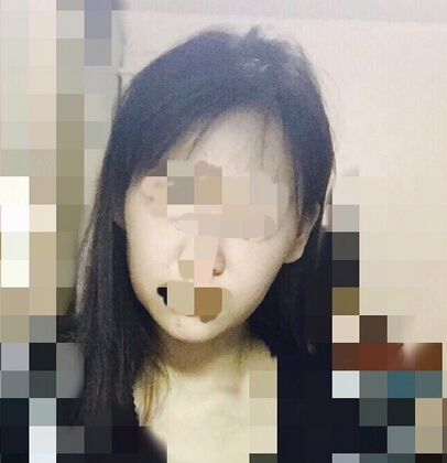 注射瘦脸案例反馈一例