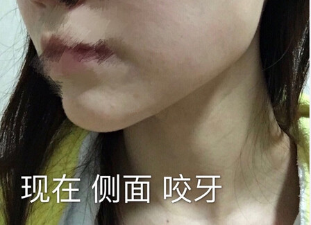 注射瘦脸案例反馈一例