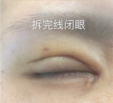 上海鹏爱做的全切双眼皮去皮去脂和开内眼角
