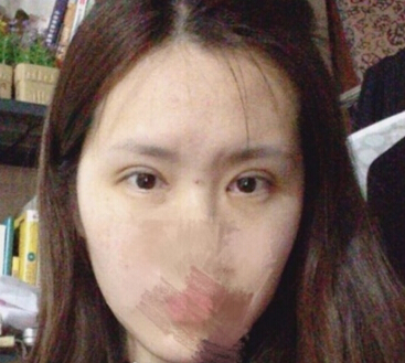 上海鹏爱做的全切双眼皮去皮去脂和开内眼角