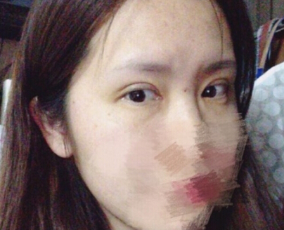 上海鹏爱做的全切双眼皮去皮去脂和开内眼角