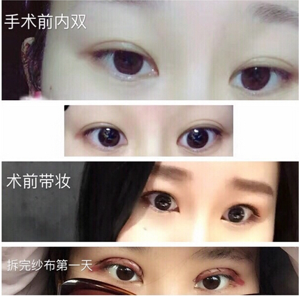 上海九院毕晓萍医生做的全切双眼皮手术果(