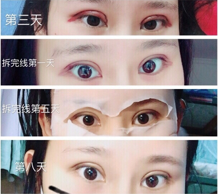 上海九院毕晓萍医生做的全切双眼皮手术果(