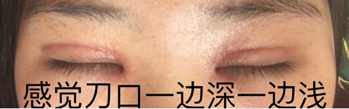 上海美联臣安薇做的双眼皮去皮去脂加开眼角