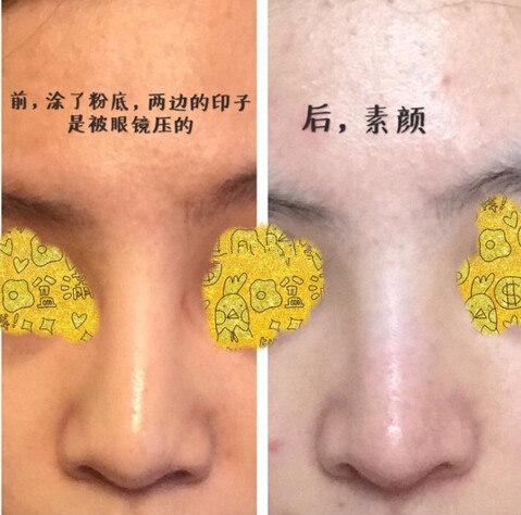 南宁美丽焦点焦俊光做的注射物取出、鼻部手术